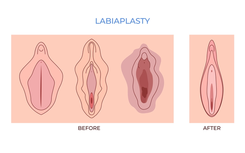 Labioplasti